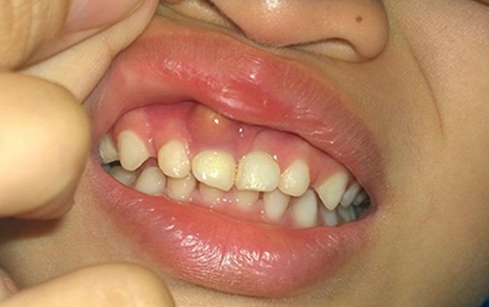 4 bệnh răng miệng thường gặp ở trẻ em các mẹ nên lưu ý