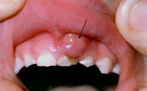 Những điều cần biết về viêm nướu răng cấp tính ở trẻ 