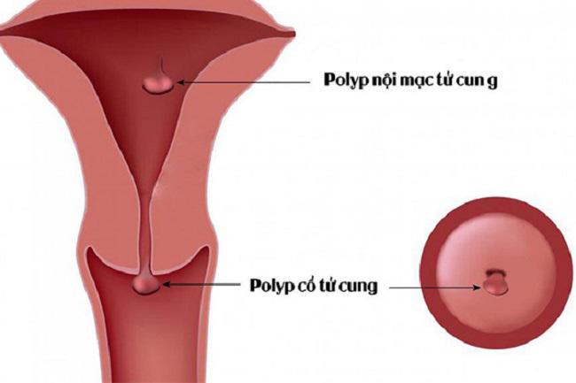Top 6  bệnh lý thường gặp ở tử cung