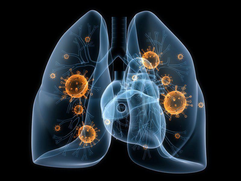 Phòng chữa bệnh viêm phổi hiệu quả