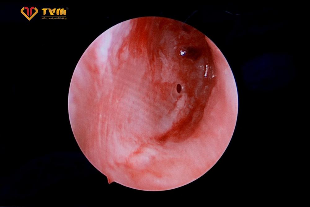 Hình ảnh nội soi trong tai bé