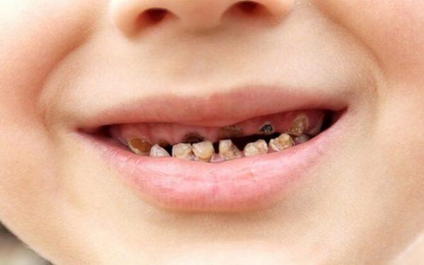 4 bệnh răng miệng thường gặp ở trẻ em các mẹ nên lưu ý