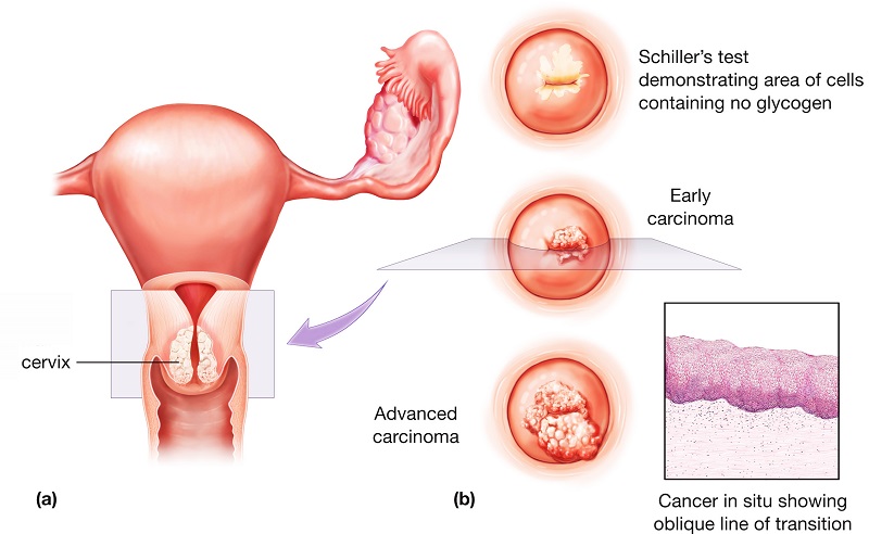 Ung thư cổ tử cung - Bệnh ung thư thường gặp ở phụ nữ Việt Nam