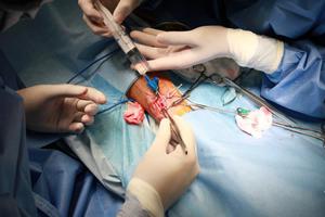 (2021) Phẫu thuật tạo rò động tĩnh mạch (FAV) - Đường sống cho bệnh nhân suy thận mạn