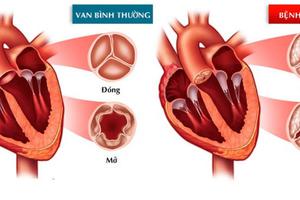 7 bệnh lý tim mạch thường gặp