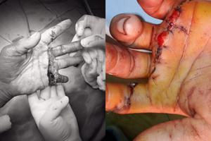 Phẫu thuật thành công ca nối bàn tay đứt lìa các ngón