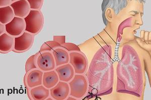 Bệnh viêm phổi - Triệu chứng của viêm phổi