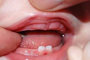 Những điều cần biết về viêm nướu răng cấp tính ở trẻ