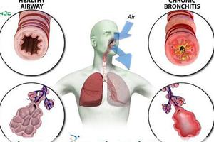 Bệnh phổi tắc nghẽn mãn tính 16 - 80% gây tử vong