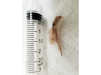 Khẩn cấp nội soi lấy dị vật xương cá dài 2cm đâm xuyên vào thực quản