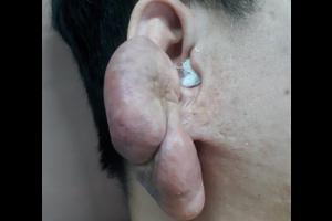 (2021) Cắt sẹo lồi vành tai tái phát to như nắm đấm