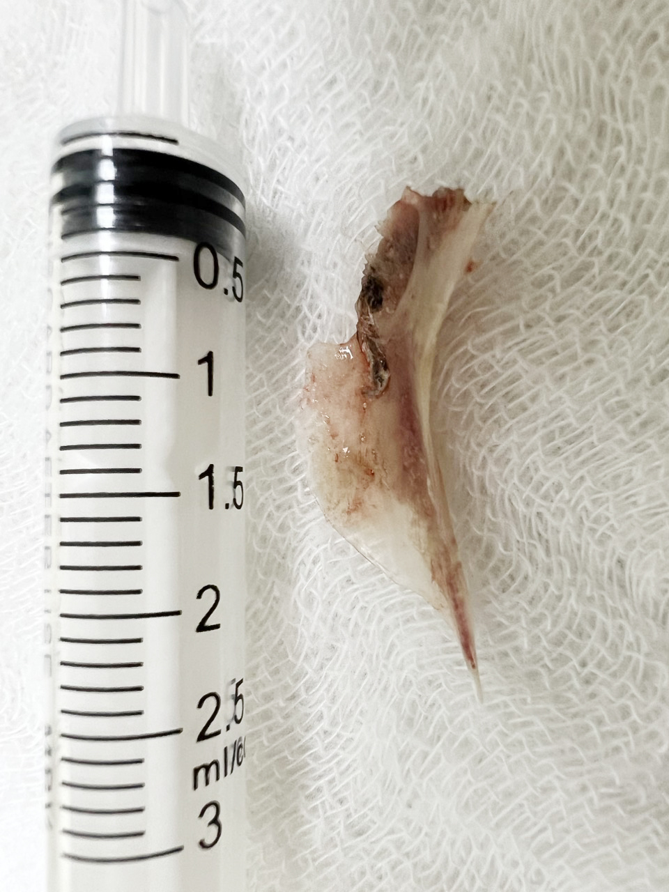 Khẩn cấp nội soi lấy dị vật xương cá dài 2cm đâm xuyên vào thực quản