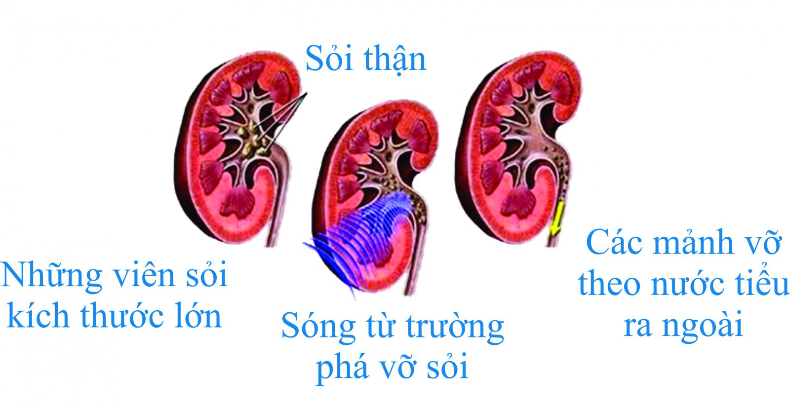 Thế náo là tán sỏi ngoài cơ thể?