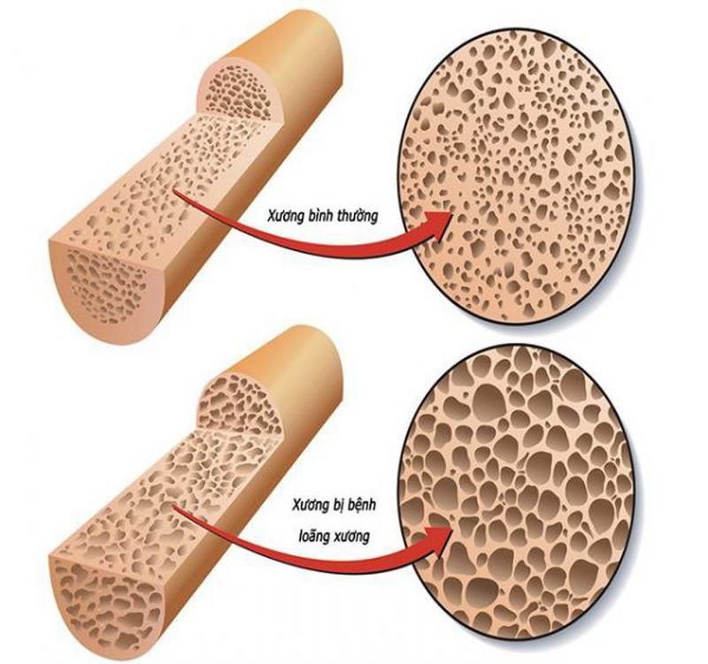 Bệnh loãng xương - Nguyên nhân và cách điều trị