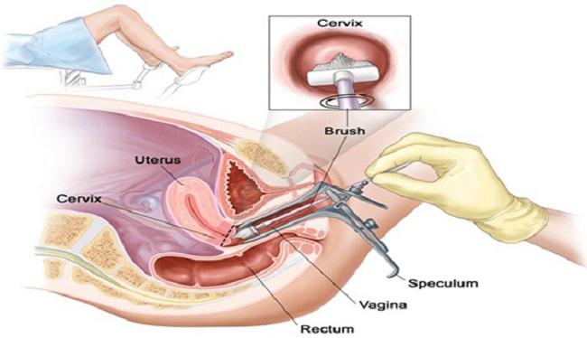 Soi cổ tử cung – Phương pháp phát hiện sớm ung thư cổ tử cung