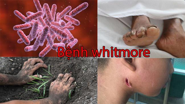 Bệnh Whitmore: Những ai có nguy cơ mắc?