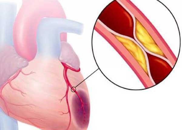 7 bệnh tim mạch thường gặp và các triệu chứng 