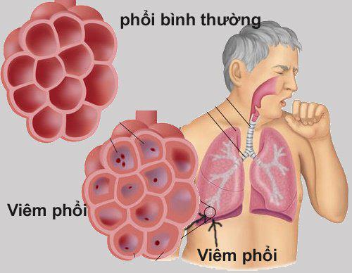 Bệnh viêm phổi - Triệu chứng của viêm phổi 