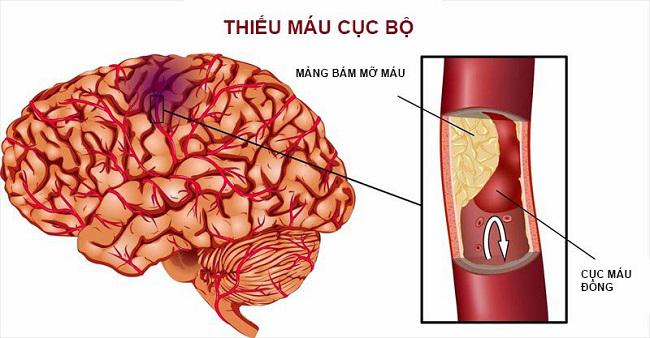 Nguyên nhân hàng đầu gây đột quỵ - Cục máu đông trong não Thanh Vũ ...