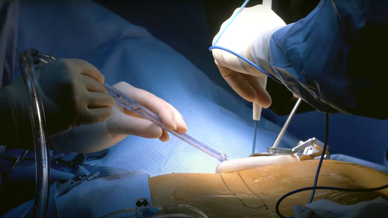Phẫu thuật nội soi lồng ngực (VATS) thực hiện như thế nào? Tất cả thông tin  về VATS - Nhà thuốc FPT Long Châu
