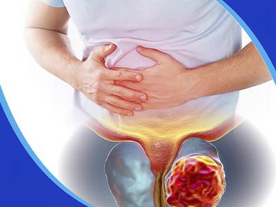 Gói tầm soát ung thư tiền liệt tuyến