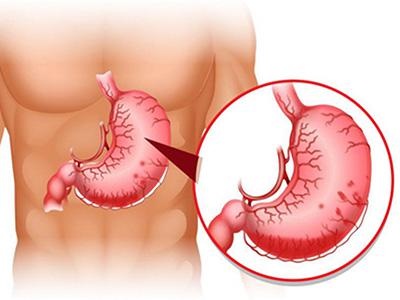 Gói tầm soát dạ dày thực quản