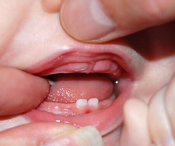 Những điều cần biết về viêm nướu răng cấp tính ở trẻ