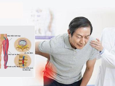 Đau thần kinh và những điều bạn cần phải biết [P2]