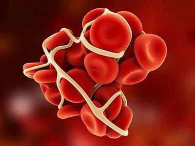Cục máu đông sau phẫu thuật và những điều cần biết