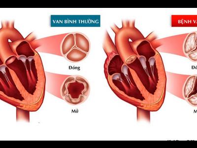 7 bệnh lý tim mạch thường gặp