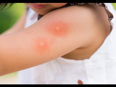 Phân biệt sốt xuất huyết và sốt phát ban