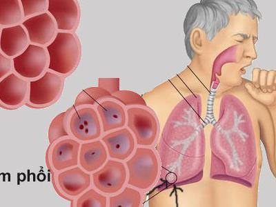 Bệnh viêm phổi - Triệu chứng của viêm phổi