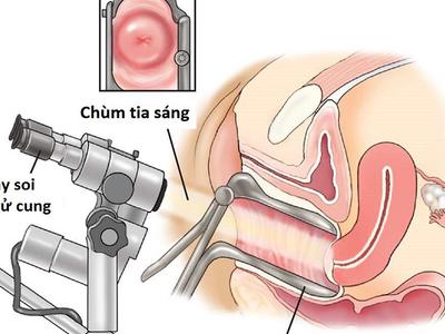 Soi cổ tử cung và những điều có thể bạn chưa biết