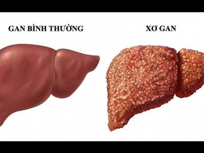 Điểm tên các bệnh thường gặp ở gan