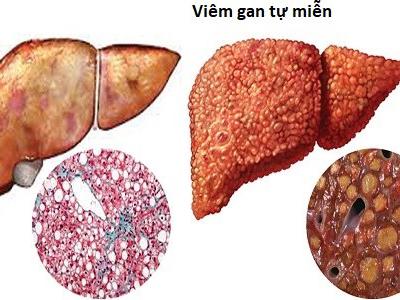 Những điều cần biết về viêm gan tự miễn